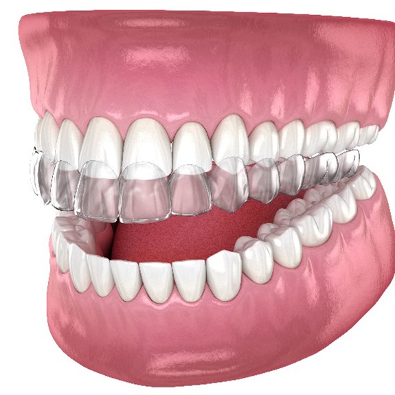 Illustration of clear aligners being placed on top teeth