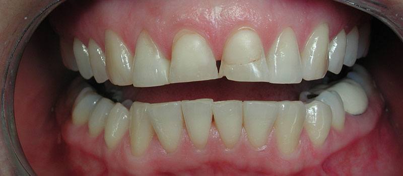 Dental patient's smile before treatment