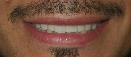 Close up of a man's flawless smile after dental treatment