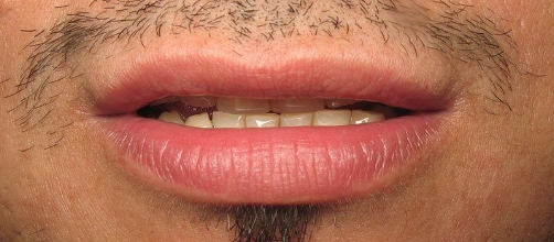 Close up of a man's smile with discolored teeth