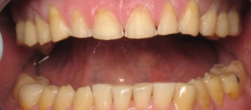 Close up of a man's discolored teeth before dental treatment