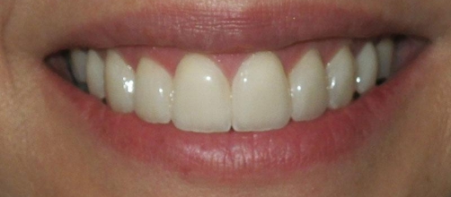 Smile after addressing chipped and yellowed teeth