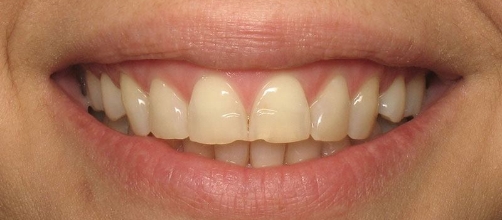 Smile with a few chipped and yellowed teeth