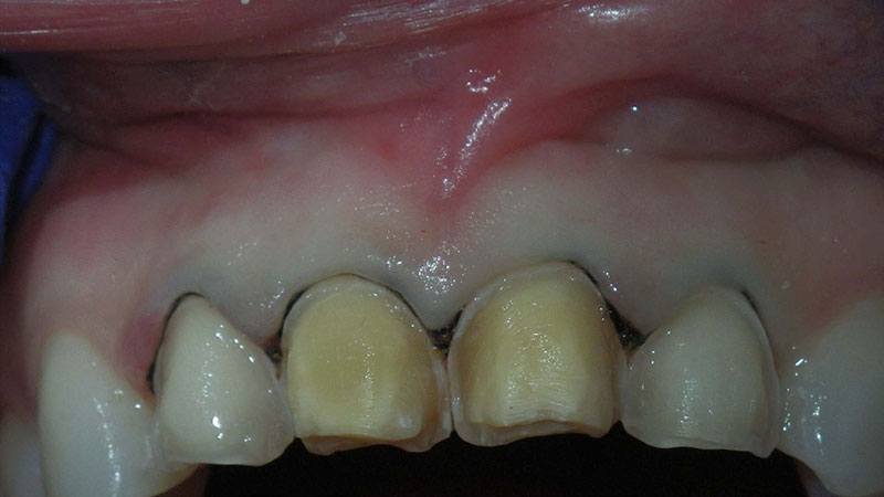 Closeup of smile prepared for minimally invasive supra gingival dentistry