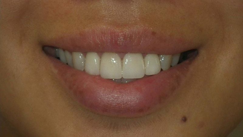 Closeup of flawless smile after dentistry