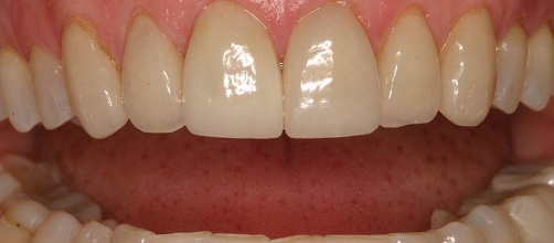 Close up of a mouth with restored and straighter teeth