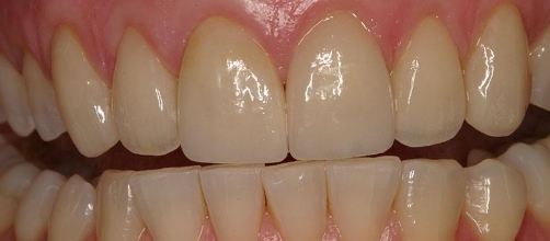 Mouth with restored and straighter teeth