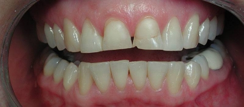 Mouth with chipped and slightly misaligned teeth