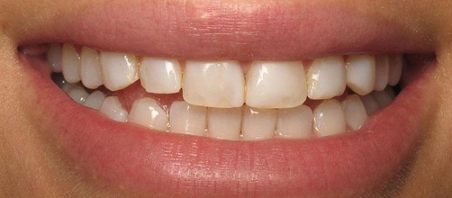 Smile with yellow staining on the teeth