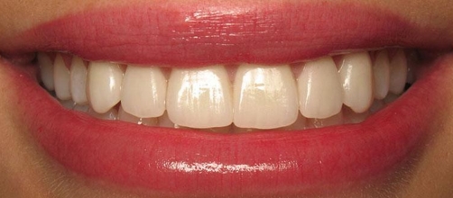 Smile after correcting yellow staining on the teeth