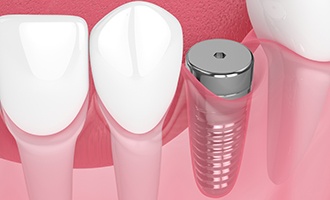 Digital illustration of a dental implant
