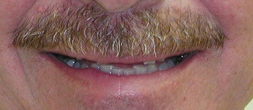 Man smiling with worn and discolored teeth