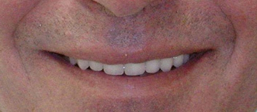 Man smiling with restored and whitened teeth