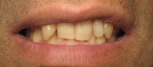 Man's smile with chipped and yellowed teeth