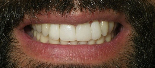 Man's smile after correcting chipped and yellowed teeth