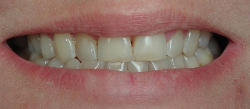 Smile with slight discoloration and gaps between some teeth