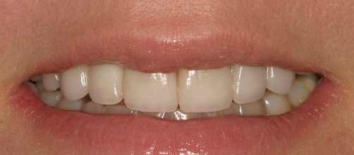 Smile after treating slightly discolored and gapped teeth