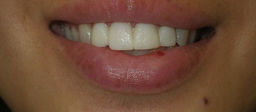 Smile with minor tooth discoloration