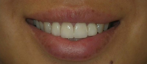 Smile after correcting minor tooth discoloration