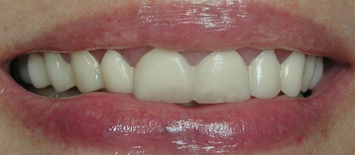 Smile with dulled teeth