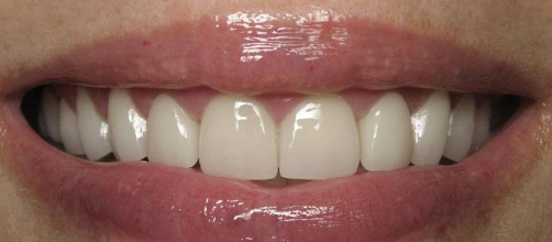 Smile with brighter teeth