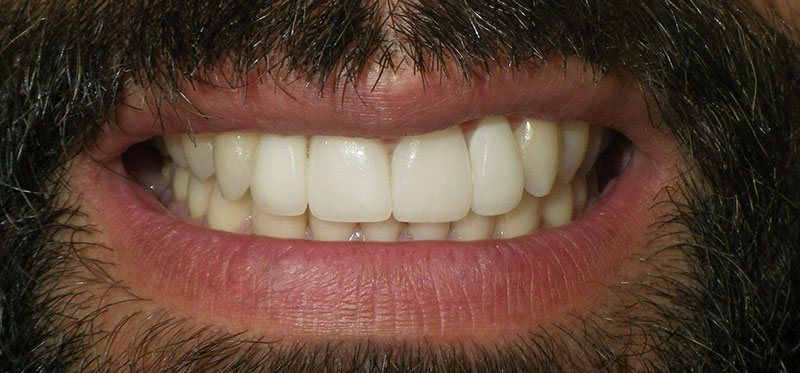 Repaired smile after restorative dentistry