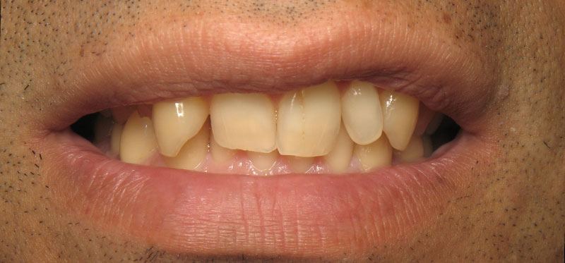 Damaged smile before restorative dentistry