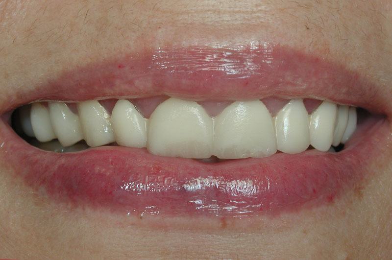 Closeup of smile with temporary veneers