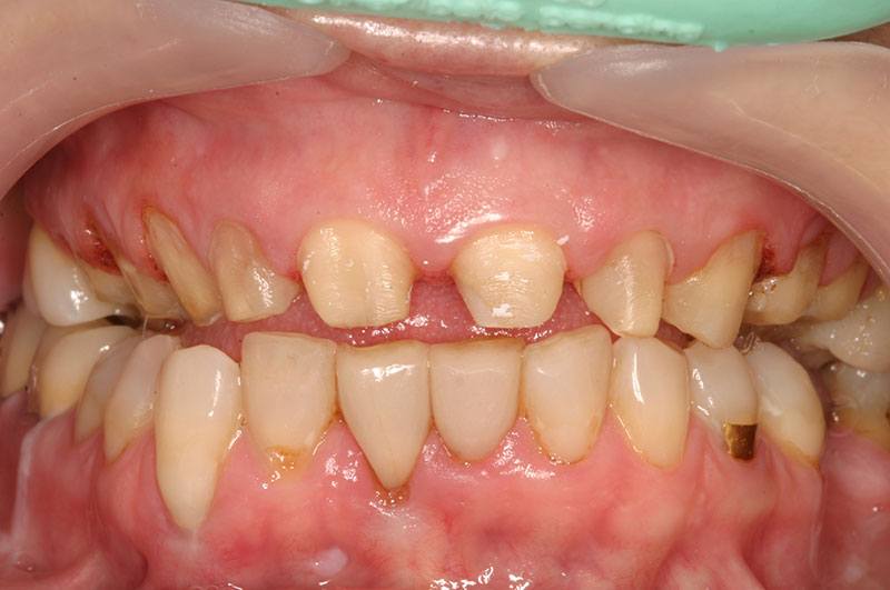 Closeup of smile prepared for permanent veneers