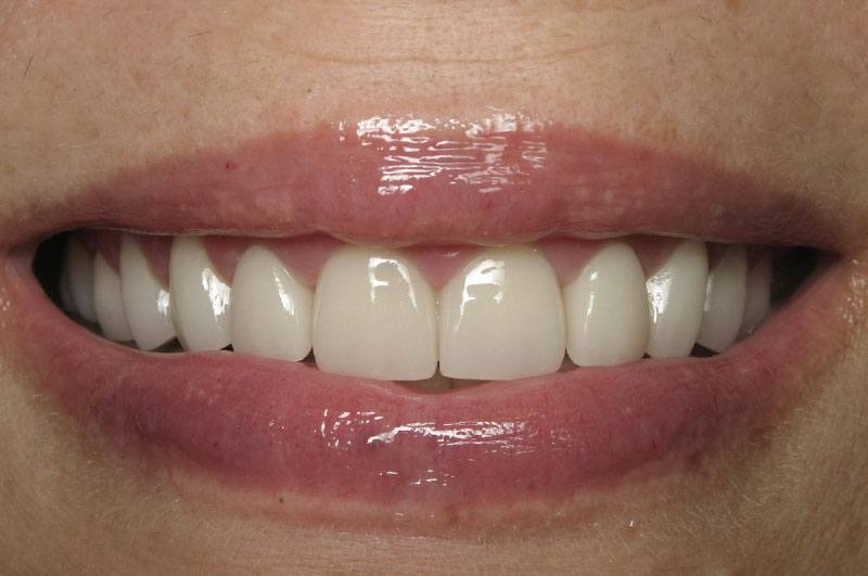 Closeup of smile with permanent veneers