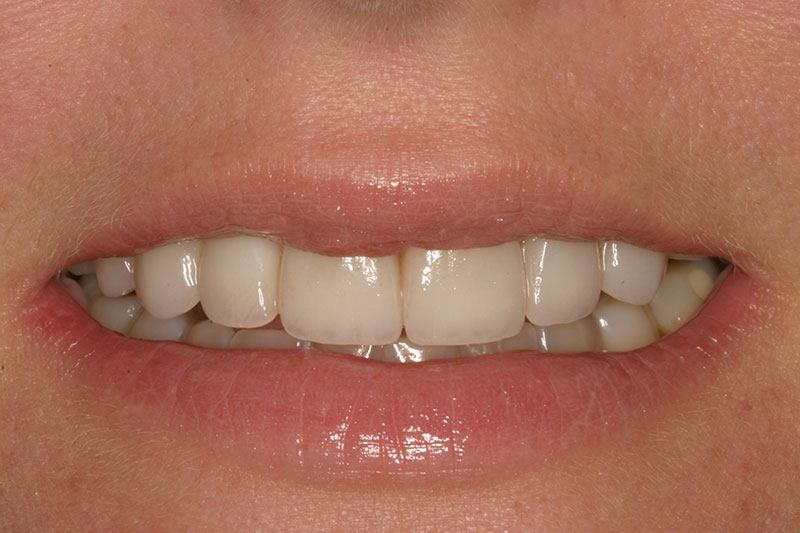 Closeup of smile after veneers