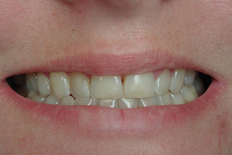 Closeup of smile before veneers