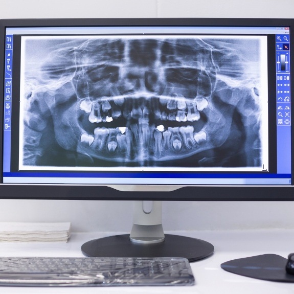 Digital dental x rays on chairside computer