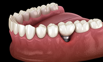 Illustration of a dental implant and crown replacing one missing tooth