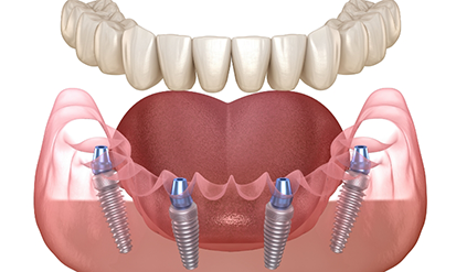 Illustration of four dental implants and a full denture replacing an arch of missing teeth