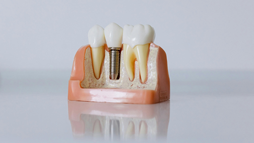 Model of a dental implant in between two natural teeth