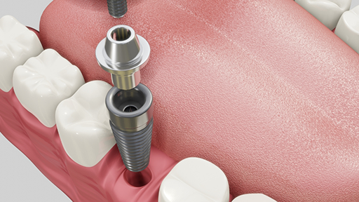 Illustration of a dental implant post, abutment, and crown being placed in the lower jaw