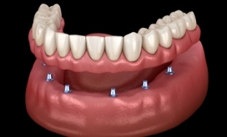 Animated smile during dental implant supported denture placement