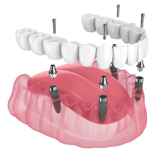 Exploded illustration of implant dentures