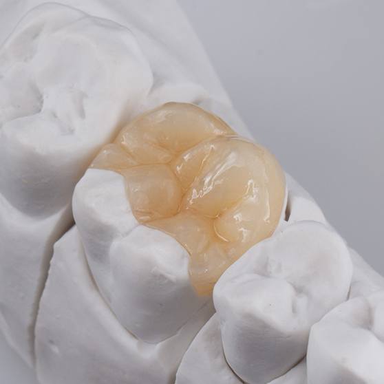 Dental onlay in Burbank, CA on model of mouth