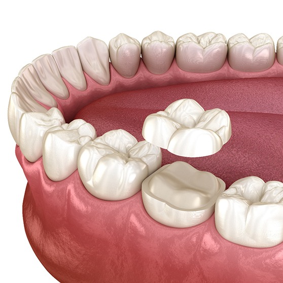 Illustration of a dental onlay in Burbank, CA being placed