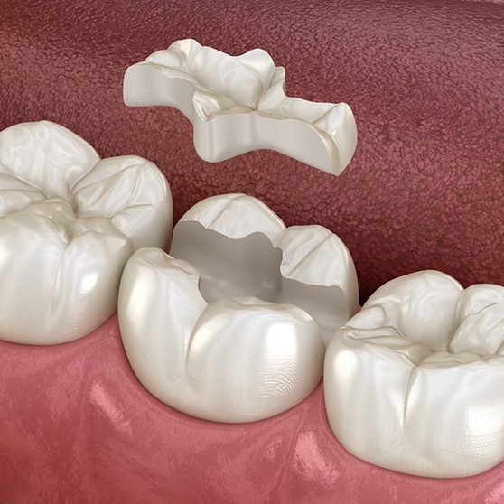 Illustration of a dental inlay being placed on tooth