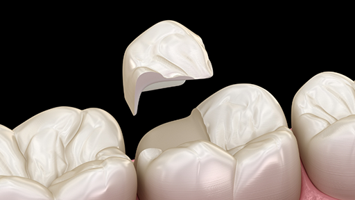 Illustration of a dental onlay being placed in a chipped tooth