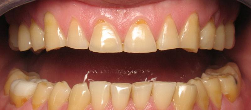 Closeup of Marlon's teeth before veneers