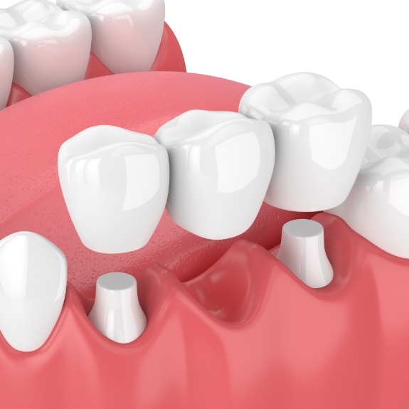 Animated smile during dental bridge placement