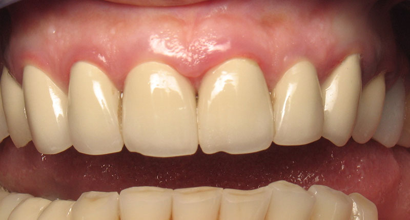 Closeup of smile after supra gingival dentistry