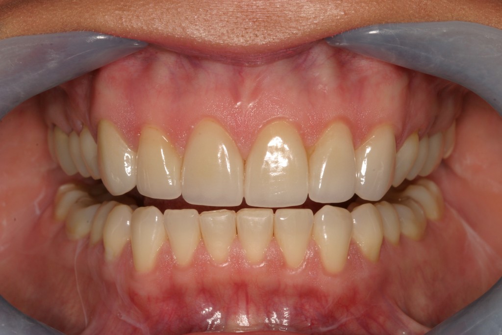 Closeup of healthy smile after supra gingival dentistry