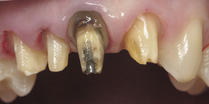 Closeup of smile during supra gingival dentistry