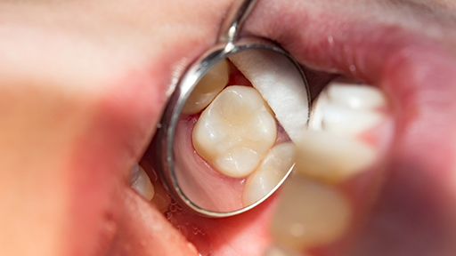 Dental mirror in a mouth reflecting a flawless tooth