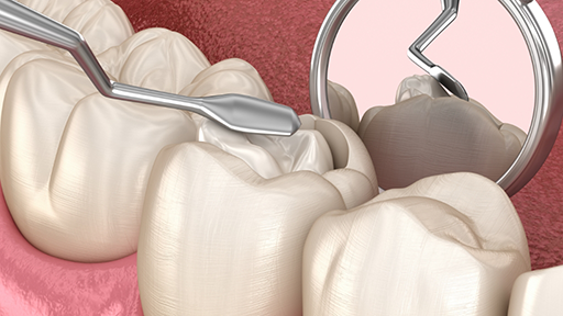Illustration of a white filling being placed in a tooth